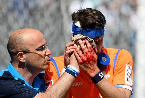 Themen der Woche - SPORT Bilder des Tages - SPORT 21.04.2018, xfux, Fussball 2.Bundesliga, SV Sandhausen - SV Darmstadt 98, emspor, emonline, v.l. Mannschaftsarzt Dr. Alexander vfLesch (SV Darmstadt 98), Romain Bregerie (SV Darmstadt 98) receive an injury, bruise, harried, hurt, injured, injury, trauma, disappointed, crestfallen, verletzt, Verletzung, Blut, blutet, rot, blood im Gesicht Sandhausen
