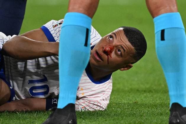 Bilder des Jahres 2024, Sport 06 Juni Sport Themen der Woche KW25 Sport Bilder des Tages 17.06.2024, xjhx, Fussball EM 2024, Österreich - Frankreich emspor, v.l. Kylian Mbappe Lottin (Frankreich) mit Schmerzen, verletzt, Verletzung blutet Nase Nasenbluten (DFL DFB REGULATIONS PROHIBIT ANY USE OF PHOTOGRAPHS as IMAGE SEQUENCES and or QUASI-VIDEO) Düsseldorf