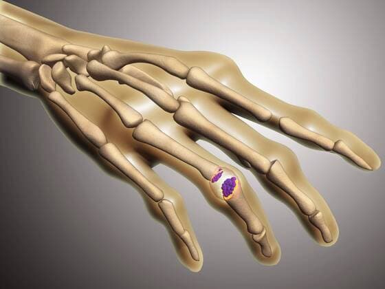 Conceptual image of rheumatoid arthritis (RA) in the human hand. RA is a chronic inflammatory disorder that typically affects the small joints in your hands and feet.  Copyright: StocktrekxImages STK701011H