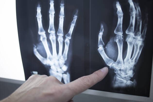 Female medical doctor pointing with finger at radiograph x-ray image on viewing light screen monitor showing hand of patient in scan. ÂxCopyrightxEdwardxOlivexAllxrightsxreserved.xTodosxderechosxreservados. 1053_RF_04_15757324