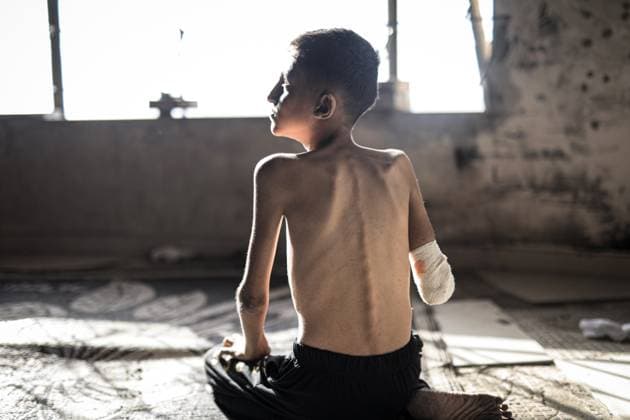 Bilder des Jahres 2025, News 06 Juni News Themen der Woche KW23 News Bilder des Tages Palestinian Ahmad, 14, injured in Gaza, awaits treatment GAZA CITY, GAZA - MAY 31: Ahmad Falih Versh Agha, a 14-year-old boy living in a shelter on Rashid Street, west of Gaza City, who was seriously wounded in the attack on his school, is viewed on May 31, 2025 in Gaza City, Gaza. Ahmad, who lost his right arm in the attack, suffered shrapnel damage to his intestines and a broken pelvis. Ahmad, who lost his father in a previous attack, struggles with health problems due to malnutrition. Ahmad, who needs a prosthetic arm, hopes to be treated abroad. Ahmed Jihad Ibrahim Al-arini Anadolu Gaza City Gaza. Editorial use only. Please get in touch for any other usage. Copyright: x2025xAnadoluxAhmedxJihadxIbrahimxAl-arinix